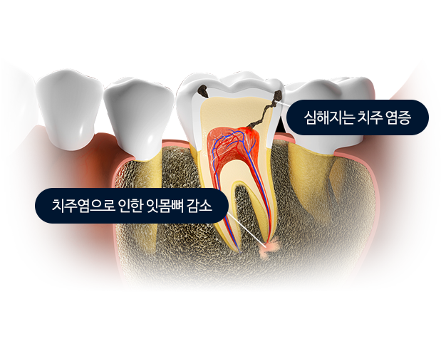 치주염으로 인한 잇몸뼈 감소 / 심해지는 치주 염증